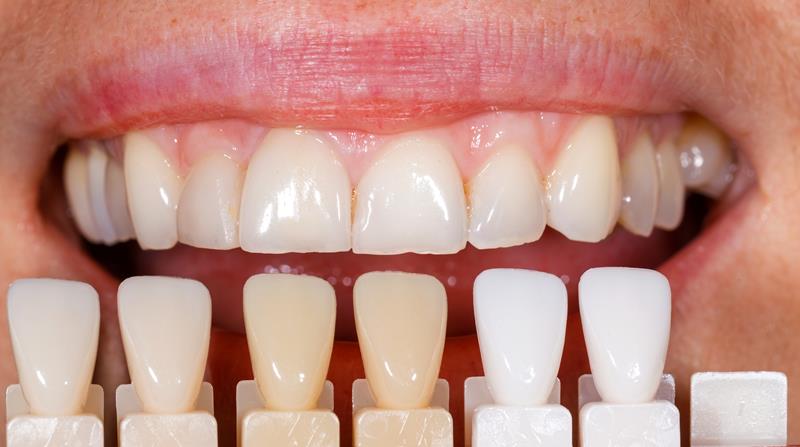 Veneers  Sylmar, CA